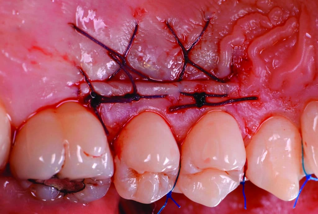 Points de suture