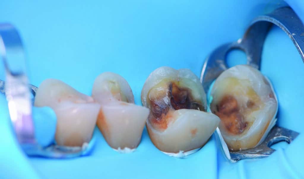 Restauration