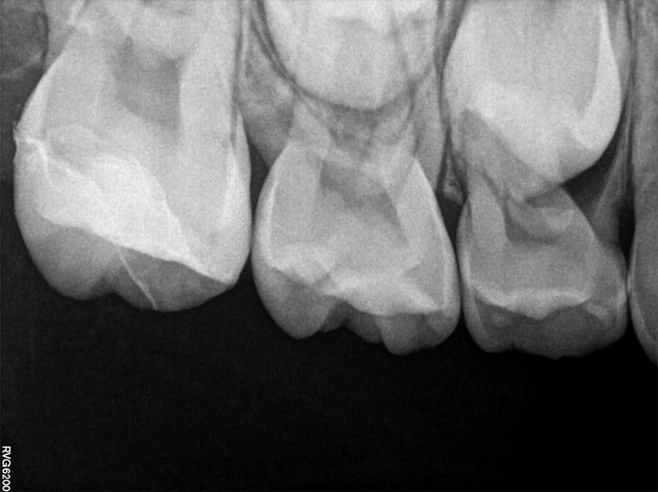 Radiographie rétroalvéolaire post-collage de l’onlay.