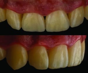 composites stratifiés