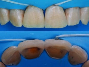 composites stratifiés