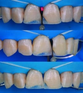 composites stratifiés