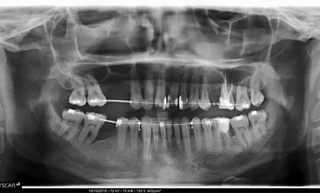 Traitement orthodontique parodonte affaibli