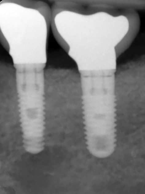 Rétro-alvéolaire des couronnes sur implants