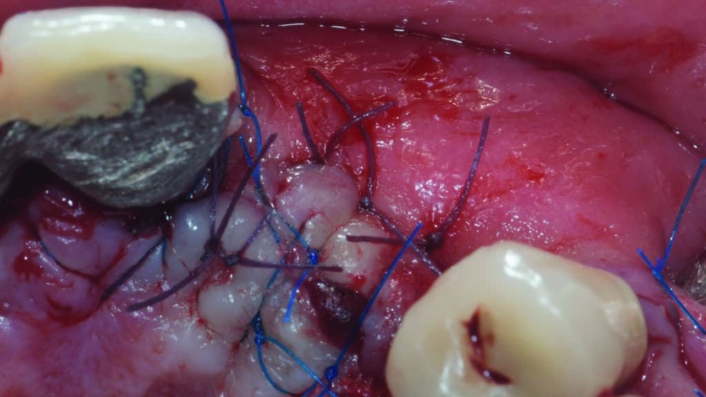Sutures du site receveur