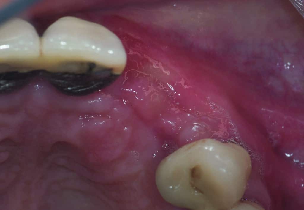 Fig.9 : Vue occlusale post-greffe à 4 mois.