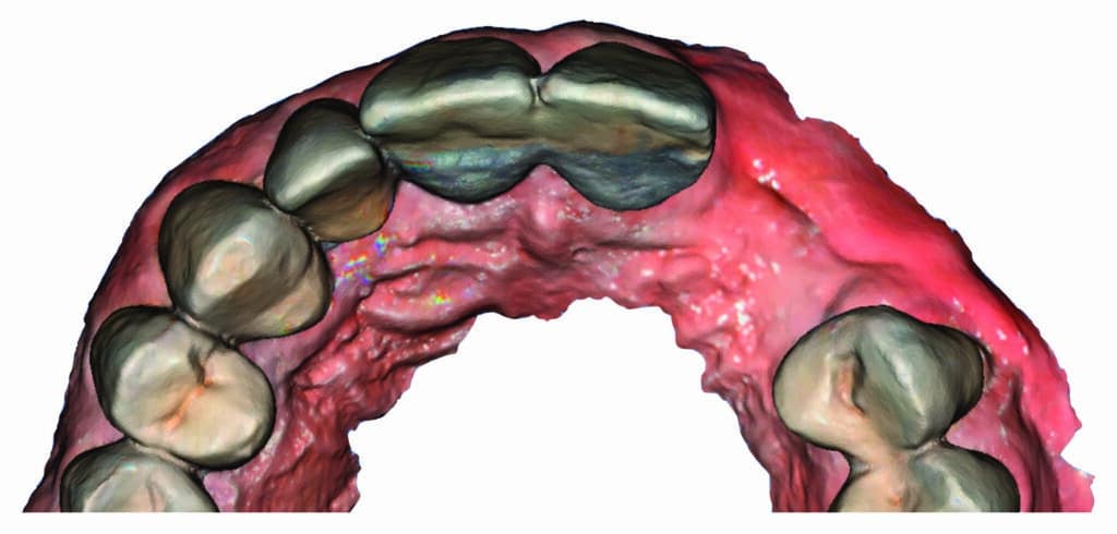 Fig.11 : Empreinte optique en vue occlusale
