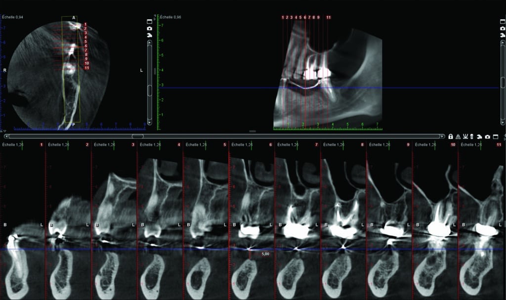 CBCT initial