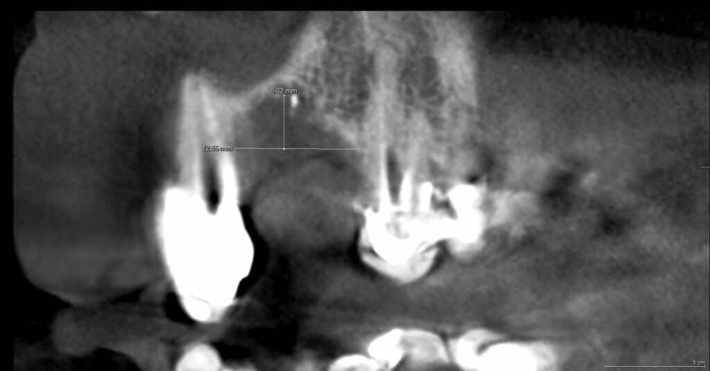 Coupe cone beam