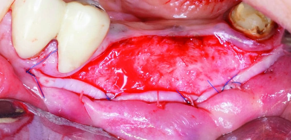 Approfondissement vestibulaire combiné à une greffe gingivale 