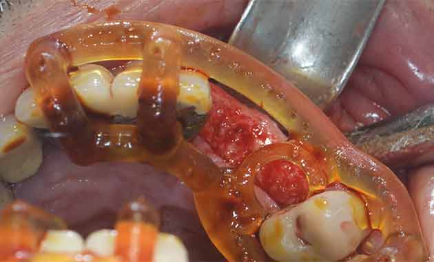 Mise en place d'un implant