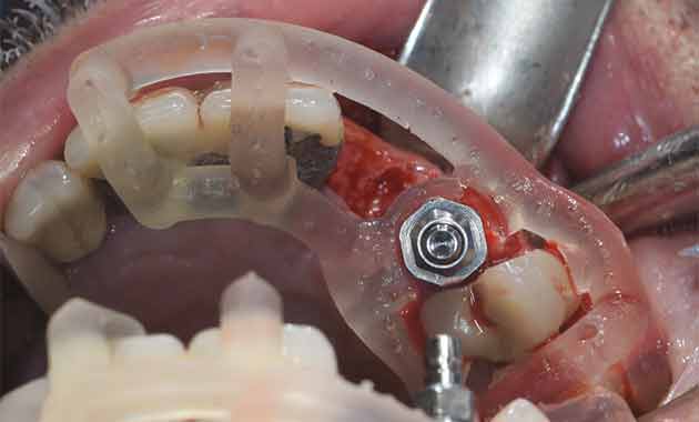 Pose d'implant