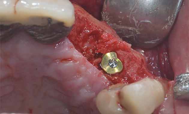Pose d'implant