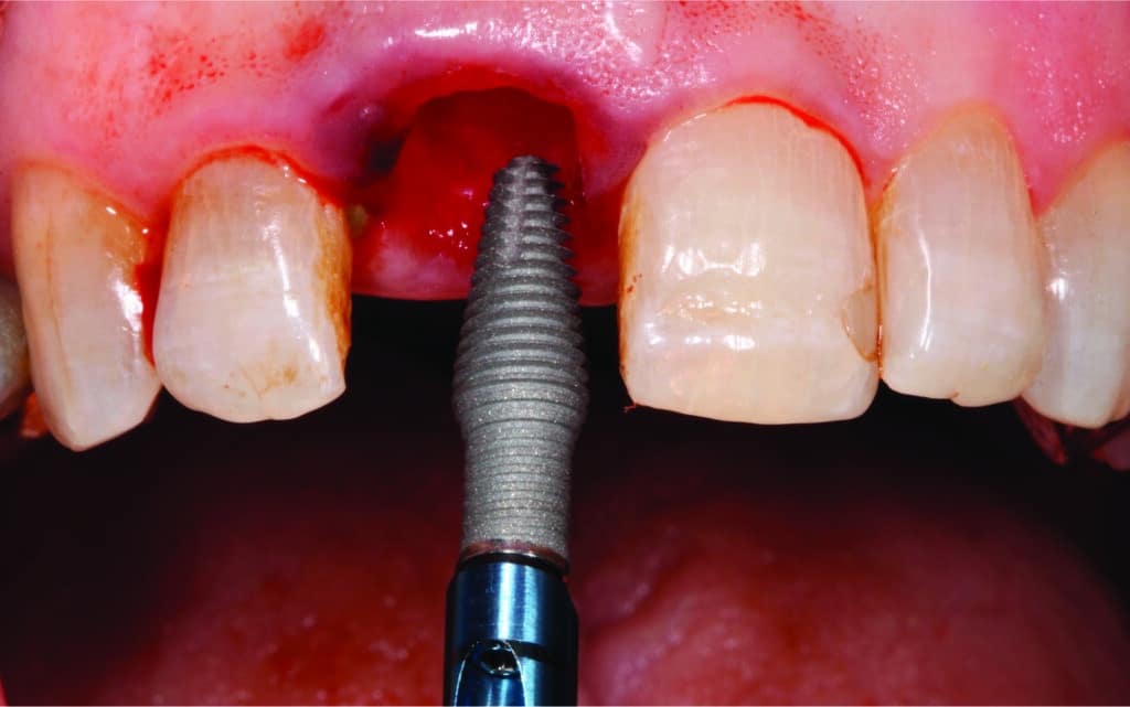 Implant Inverta