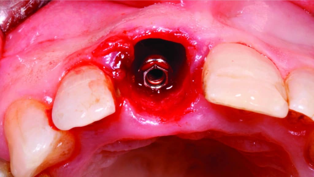 Implant en place et visualisation du gap