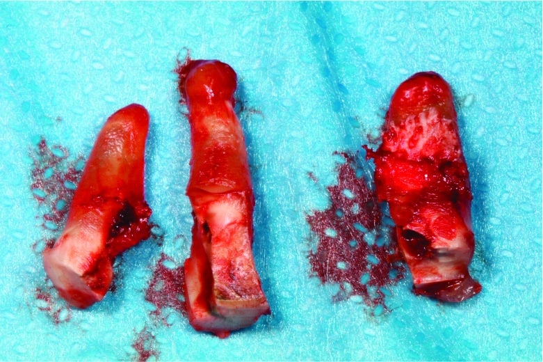 Racines après avulsion