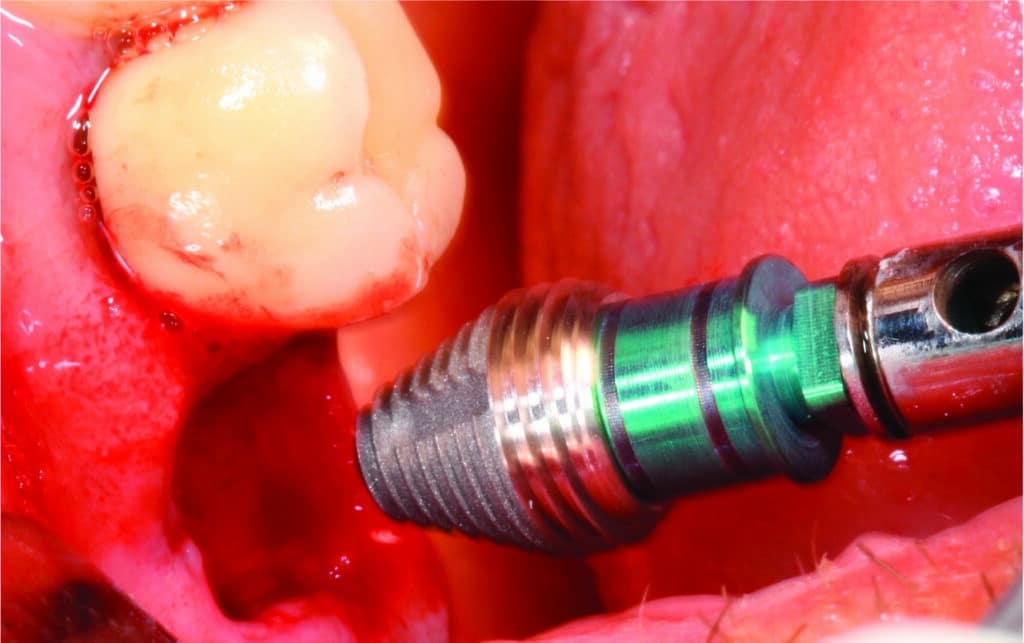 Mise en place d'un implant Max