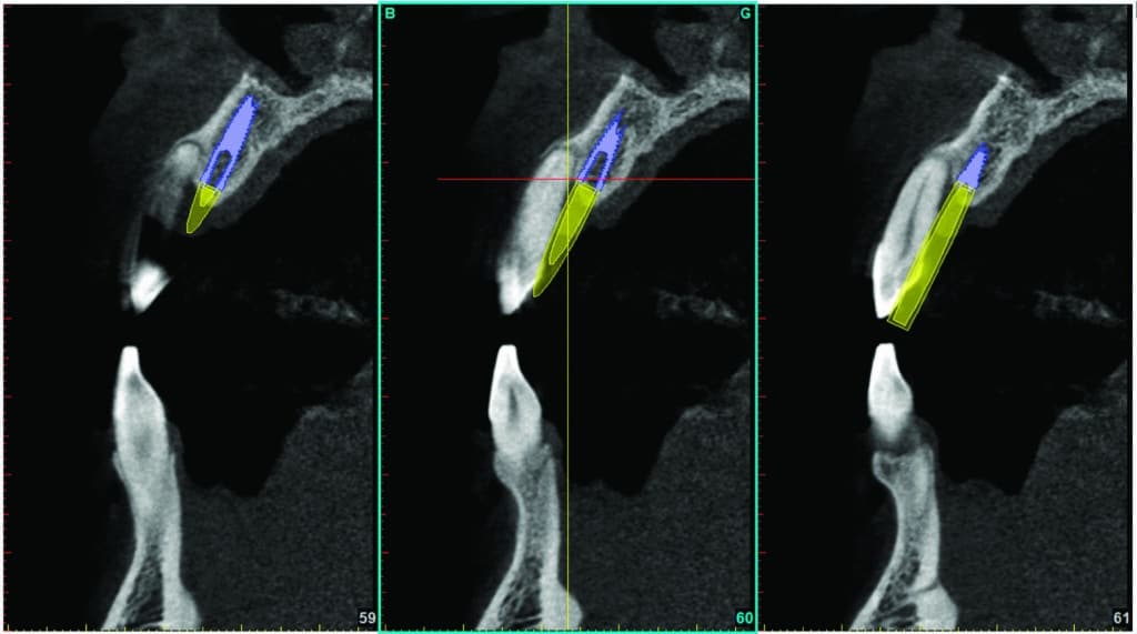 Position contre la paroi osseuse vestibulaire d'une incisive maxillaire versus position de l'implant.