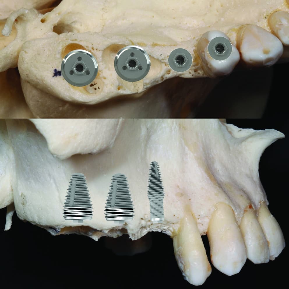 Placement 3D des implants