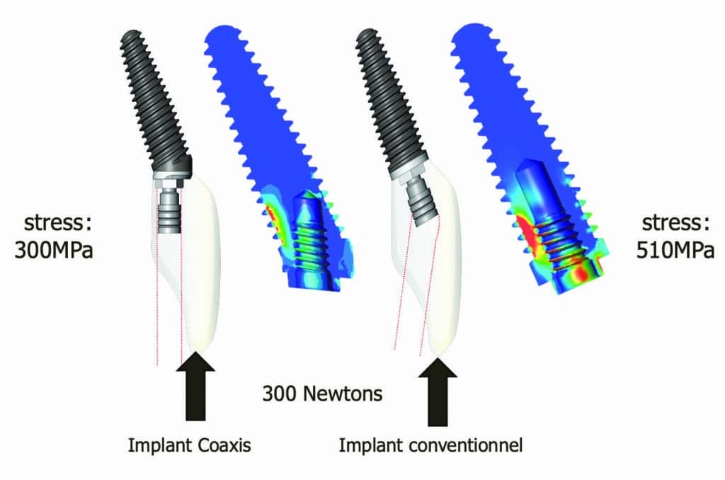 Stress au niveau cervical de l'implant