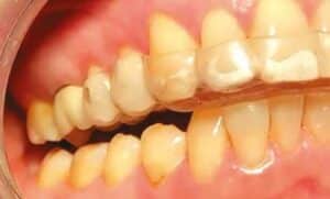 Dysfonction craint-mandibulaire