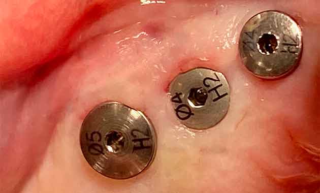 Implantologie Flapless