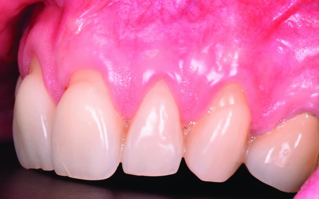 récessions gingivales