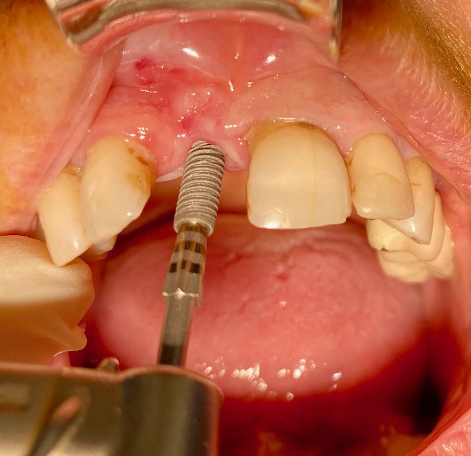 Insertion de l'implant
