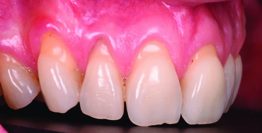Récessions gingivales