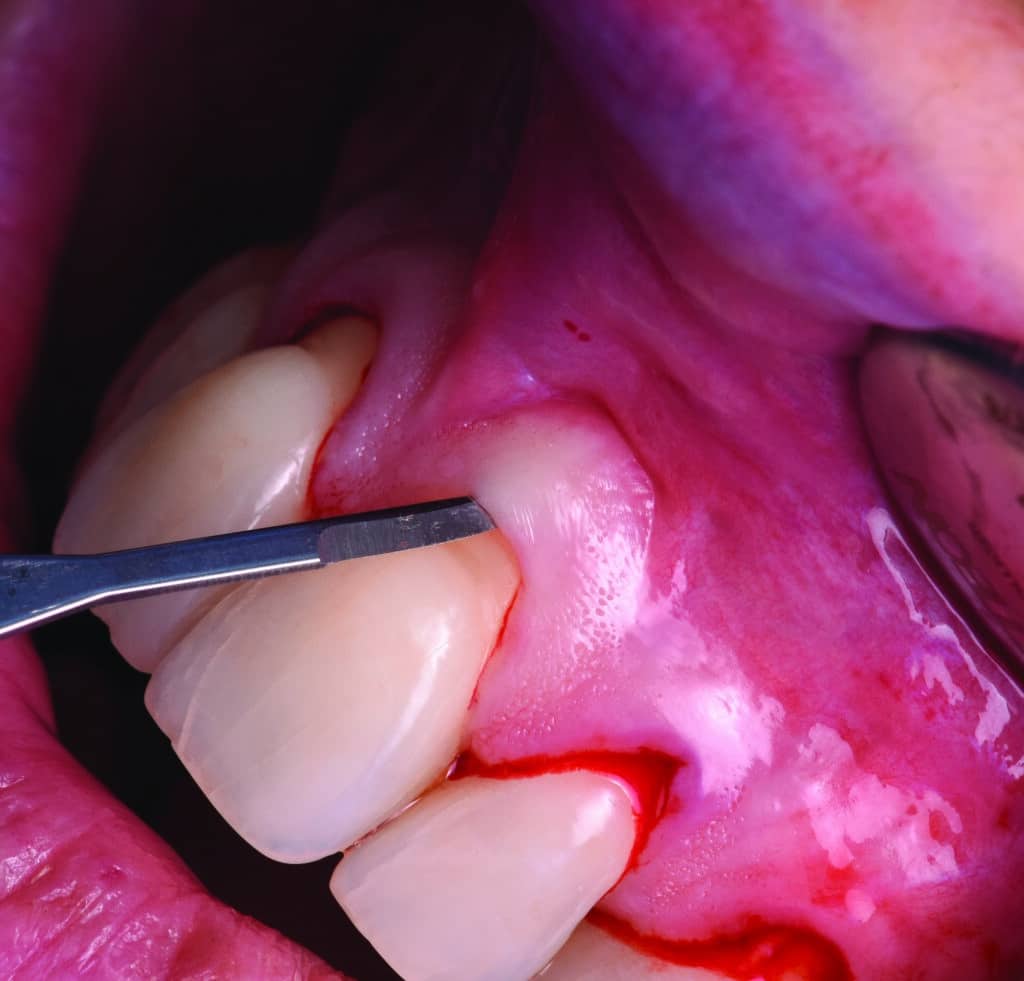 Incisions intrasulculaires