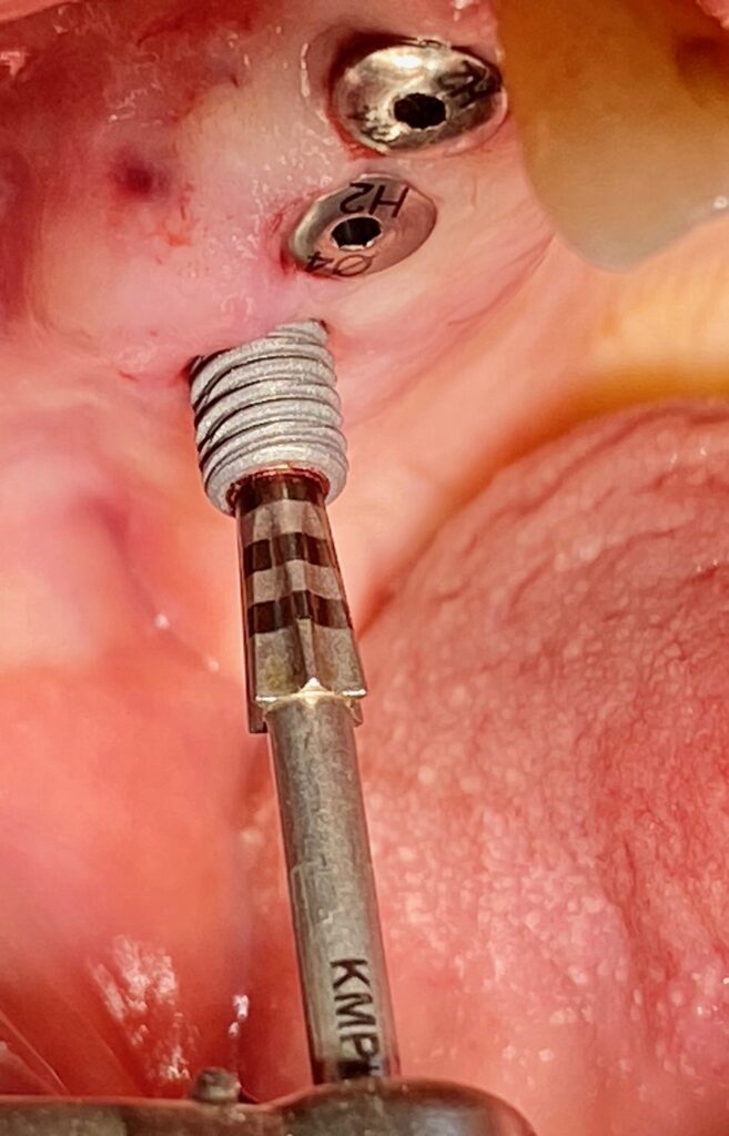 insertion de l'implant