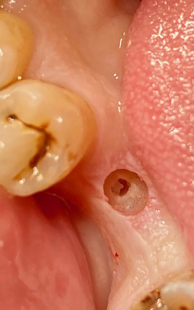 Implantologie flapless