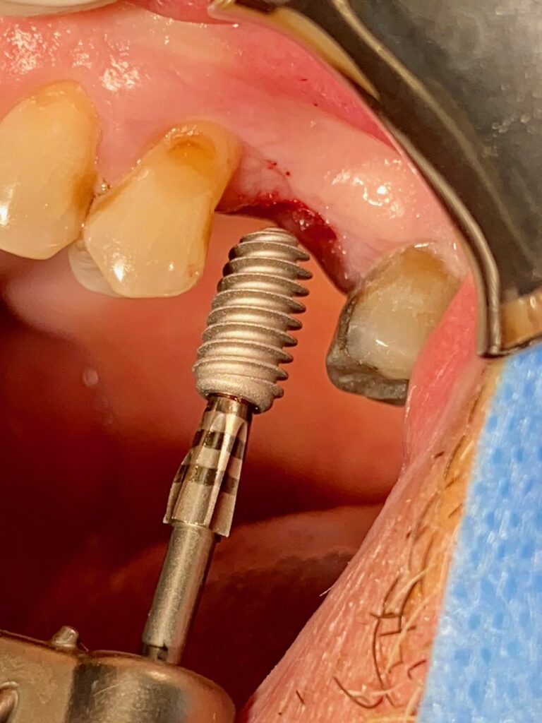 implant Kontact S+