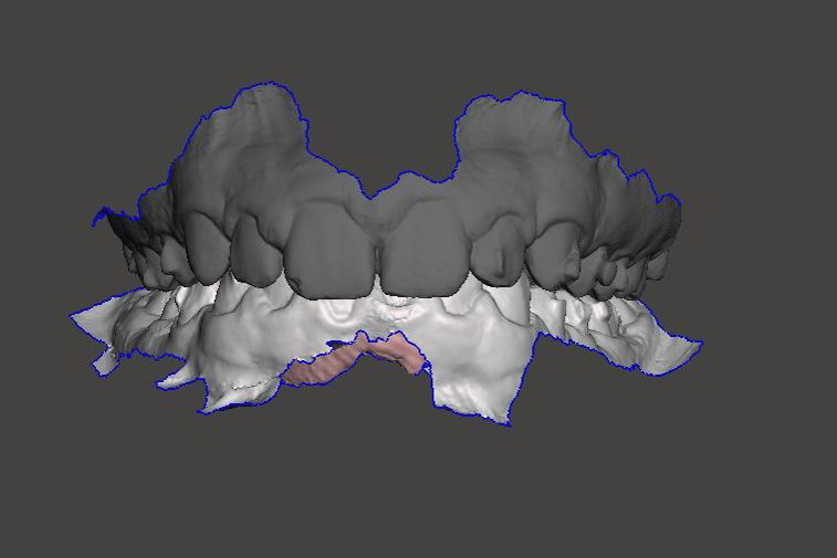 Fichier STL issu de l'empreinte optique intraorale
