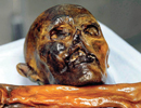 L’homme congelé du Néolithique, Ötzi, et ses problèmes dentaires