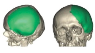 Un implant crânien en titane réalisé avec une imprimante 3D
