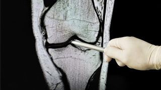 Ostéoporose : comment préserver l’équilibre entre formation et destruction de l’os ?