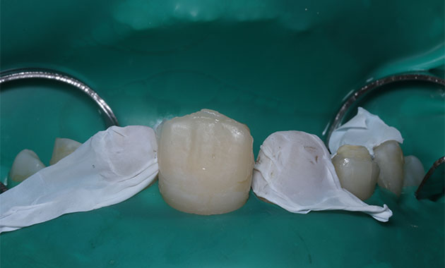 Restaurations esthétiques antérieures du sourire après chirurgie orthodontique