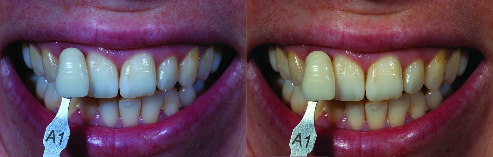 Dentaire365 La prise de teinte en dentisterie esthétique