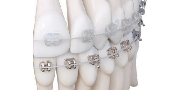 American orthodontics – nouveauté dans la gamme d’arcs : l’arc esthétique iconix se niti American orthodontics – nouveauté dans la gamme d’arcs : l’arc esthétique iconix se niti