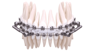 AMERICAN ORTHODONTICS – La correction des Classes II simplifiée