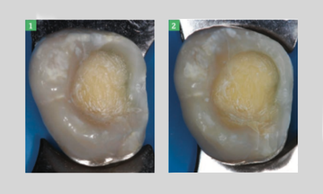 Scellement dentinaire immédiat et optimisation des protocoles de collage