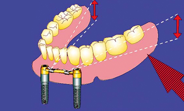 Prothèse amovible sur implants : proposition pour une solution bio-fonctionnelle