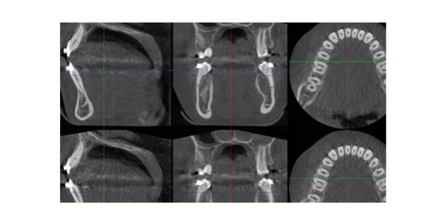 Compenser les mouvements sur les images CBCT