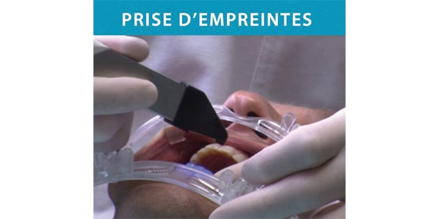 PROPHY VISION PAR EUROBYTECH – Solution innovante d’écarteurs PROPHY VISION PAR EUROBYTECH – Solution innovante d’écarteurs