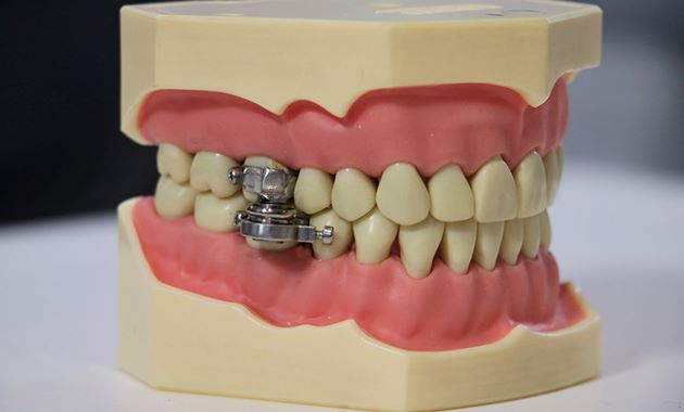 Obésité : un dispositif intrabuccal pour aider les patients à maigrir ? Obésité : un dispositif intrabuccal pour aider les patients à maigrir ?