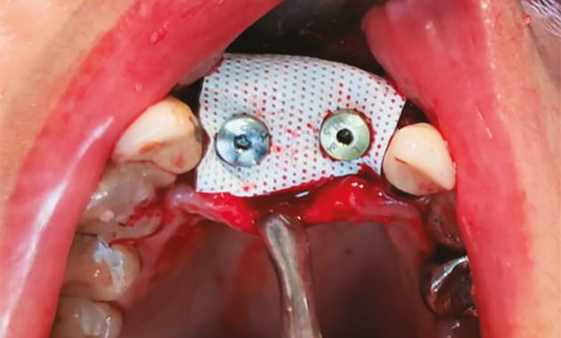 Tenter la reproductibilité et la simplicité en chirurgie d&rsquo;augmentation osseuse