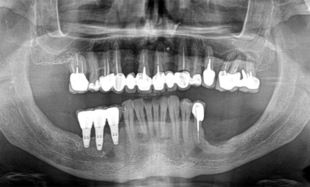 Évaluation  du niveau de  difficulté des  greffes de sinus