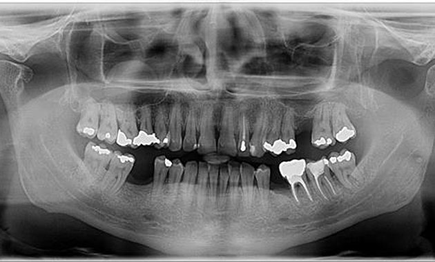 Pathologies solutionnées par l’endodontie