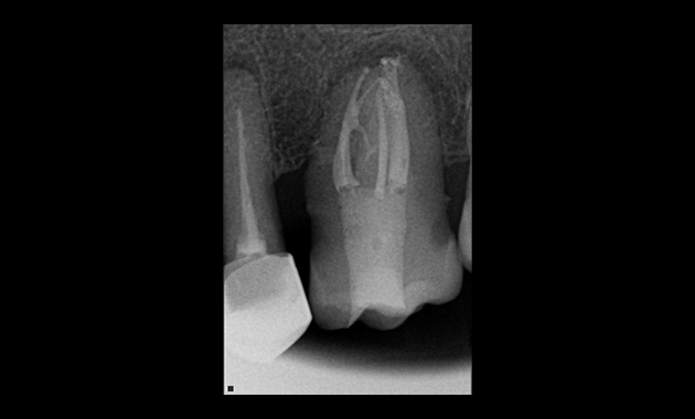 Les manifestations à distance dans le corps humain des pathologies d’origine endodontique